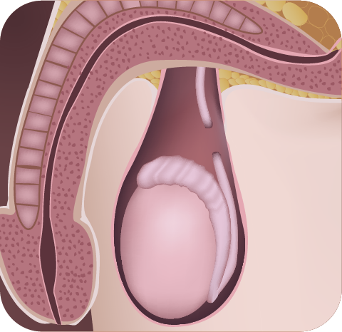 Vasectomia-Cirugia-ambulatoria