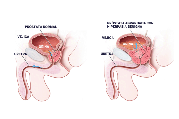 prostata-agrandada-hiperplasia-benigna