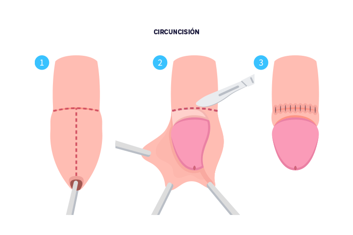 circuncision-hombres-niños