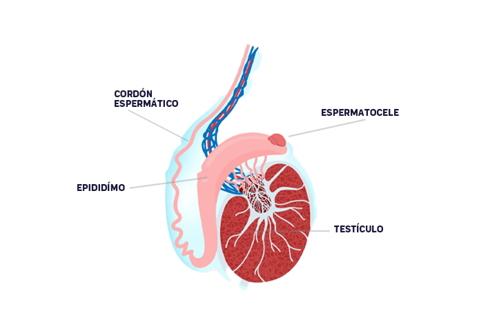 espermatocele-hombre