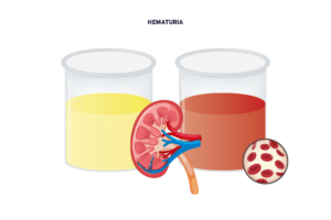 Hematuria-muestra-orina