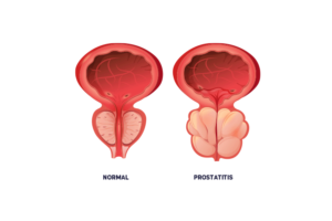 prostatitis-hombre