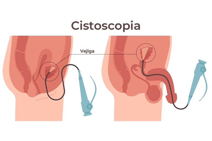 cistoscopia-procedimiento