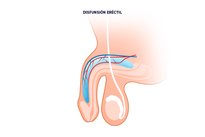disfuncion-erectil-hombres