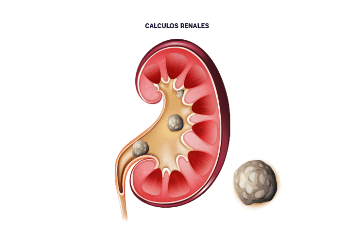 calculos-renales-adultos-niños