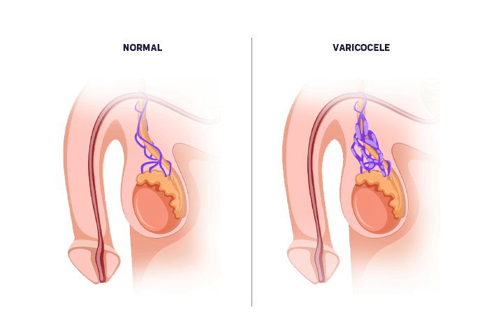 varicocele-hombres