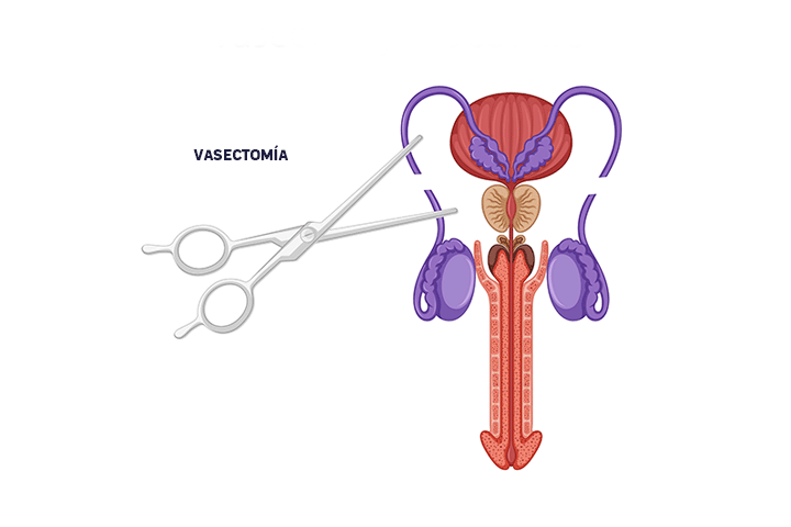 vasectomia-cirugia-hombres