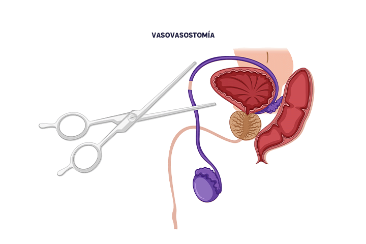 reversion-vasectomia-hombres