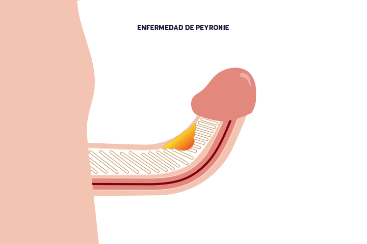 enfermedad-peyronie-hombres